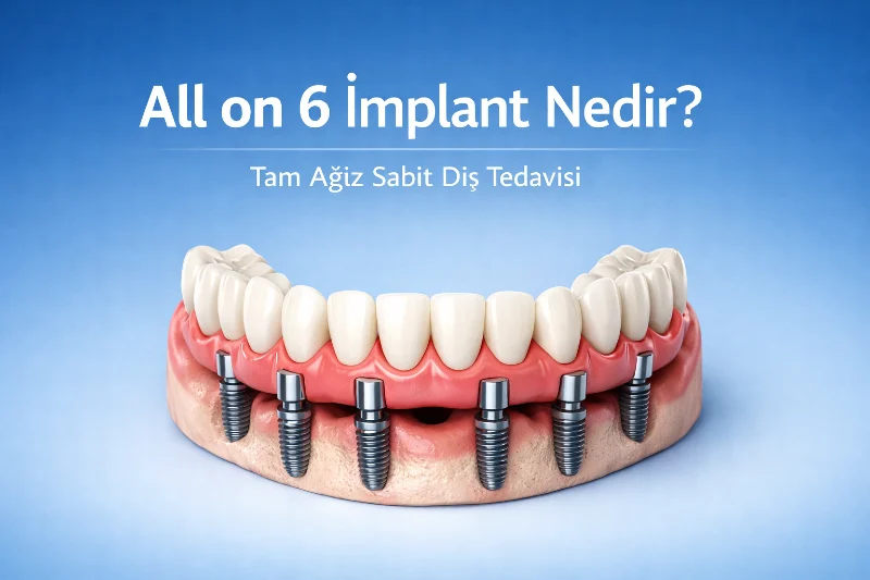All on 6 İmplant Nedir?