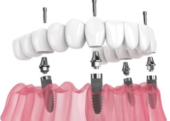 What are the advantages of All on 4 dental implants? in Turkey Istanbul Dental Clinic