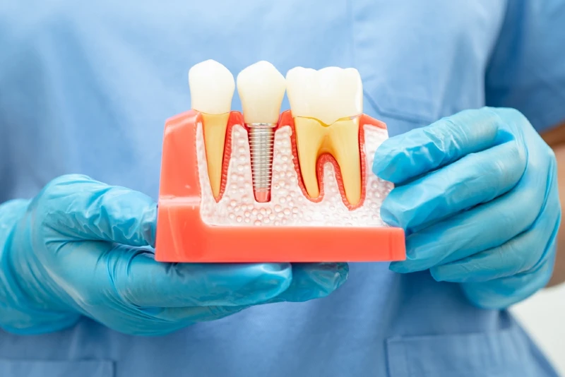 All-on-4 and All-on-6 Dental Implants - Full Mouth Restoration in Istanbul