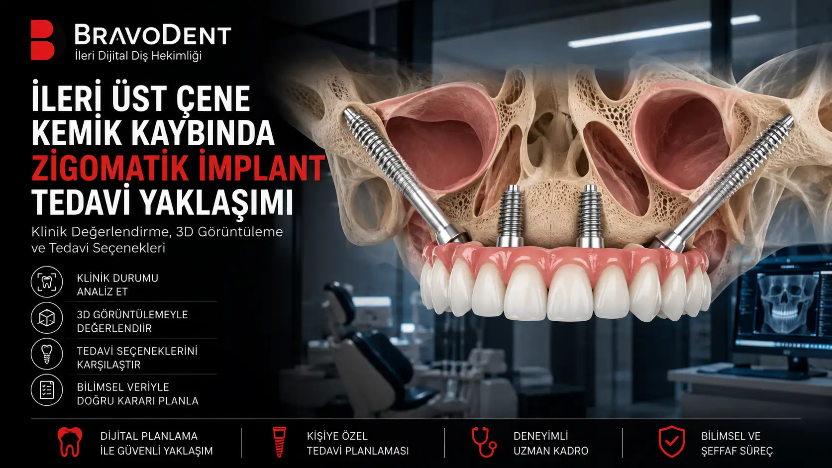 İleri Üst Çene Kemik Kaybında Zigomatik İmplant Tedavi Yaklaşımı