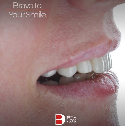 What are laminate veneers made of? & What are the benefits of laminated veneer? in Turkey, Istanbul Dental Clinic